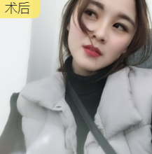 双眼皮手术
