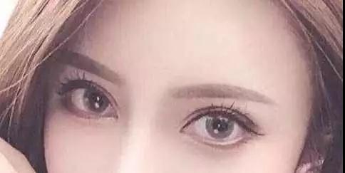 双眼皮手术