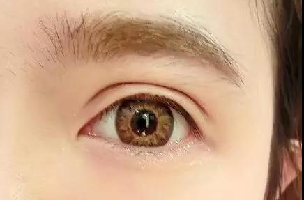 双眼皮手术