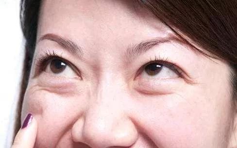 去眼袋手术