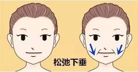 面部提升术
