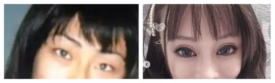 双眼皮手术
