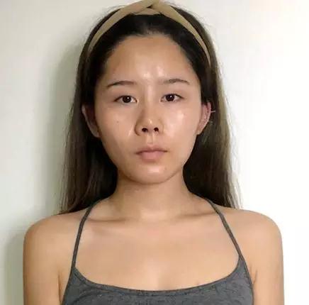 双眼皮手术