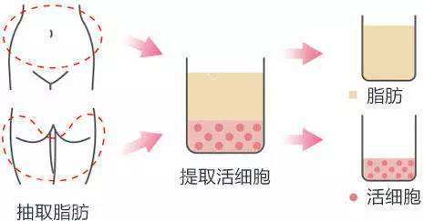 自体脂肪填充术
