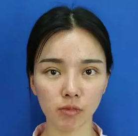 自体脂肪填充术