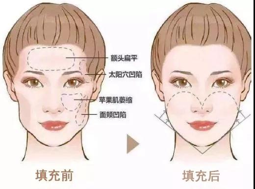 自体脂肪填充术