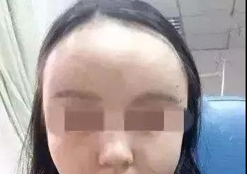自体脂肪填充术