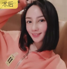 隆鼻手术