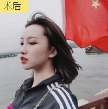 隆鼻手术
