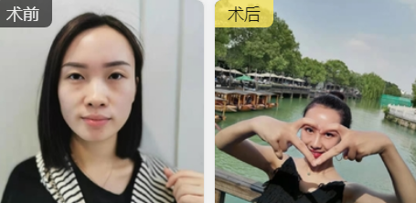 隆鼻手术