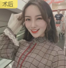 隆鼻手术