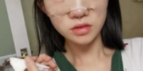 隆鼻手术