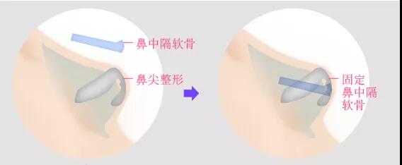 隆鼻手术