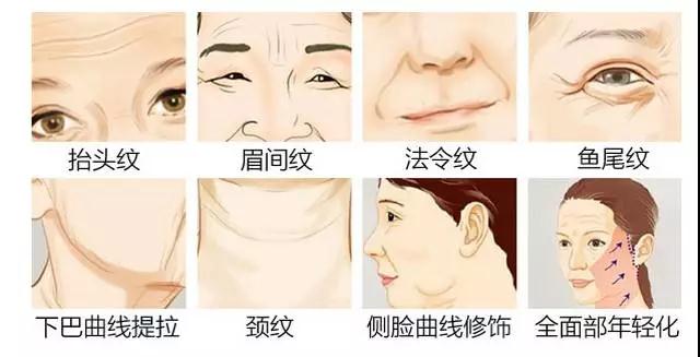 面部提升术