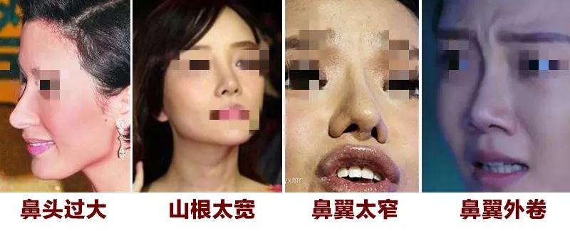 隆鼻手术