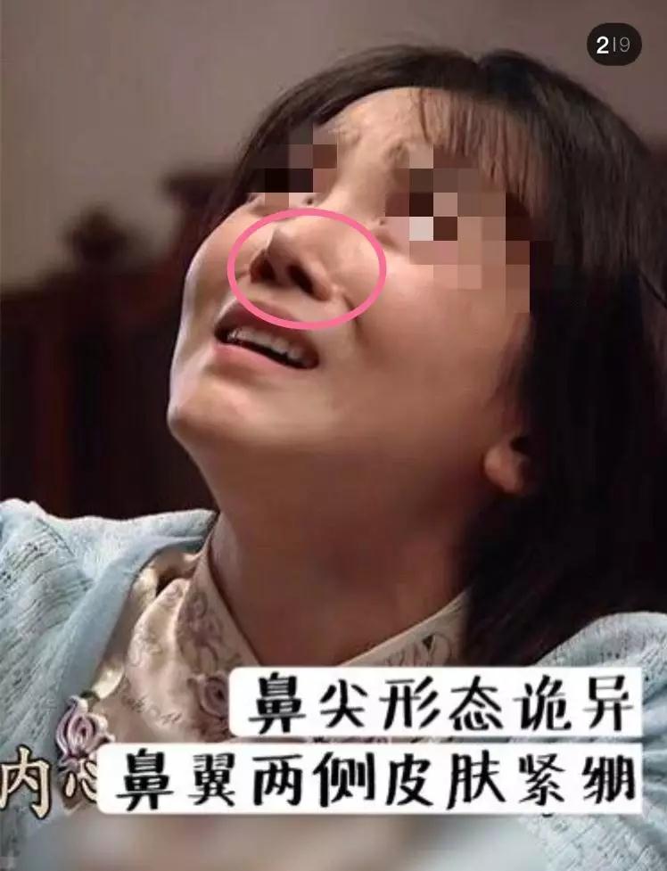 隆鼻手术