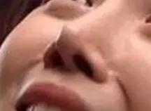 隆鼻手术