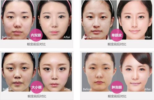 双眼皮手术