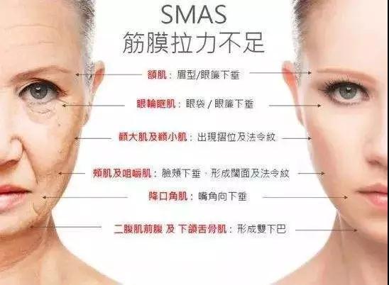 面部提升术