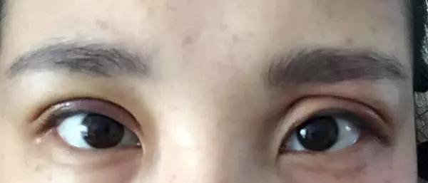 双眼皮手术