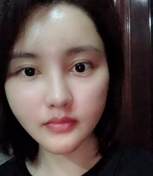 自体脂肪填充术