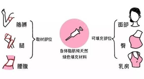 自体脂肪填充术