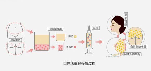 自体脂肪填充术