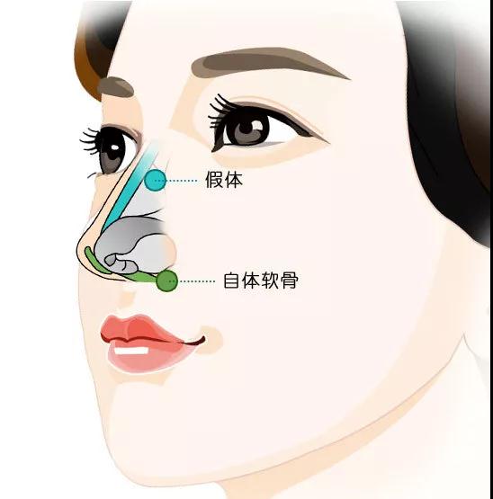隆鼻手术