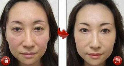 去眼袋手术