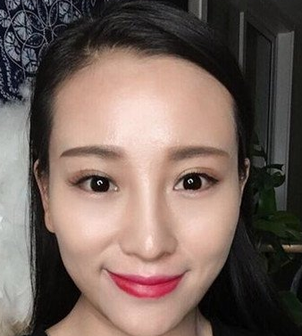 去眼袋手术