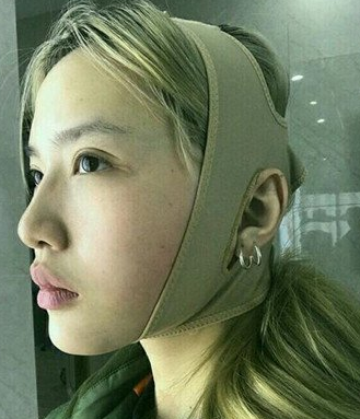 超声波瘦脸
