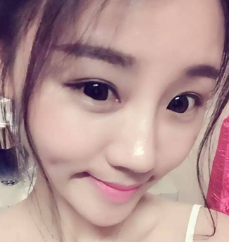 双眼皮手术