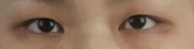 双眼皮手术