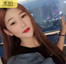 双眼皮手术