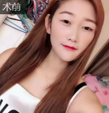 双眼皮手术
