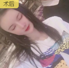 双眼皮手术