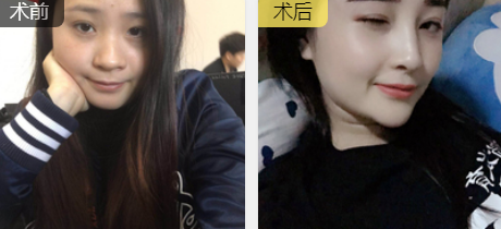 隆鼻手术