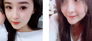 隆鼻手术