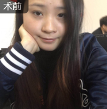 隆鼻手术