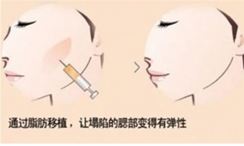 自体脂肪填充术