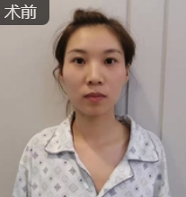 自体脂肪填充术