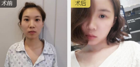 自体脂肪填充术
