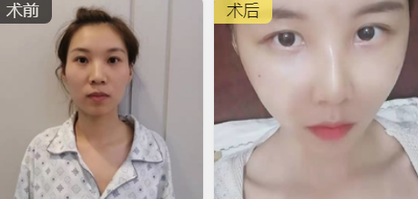 自体脂肪填充术