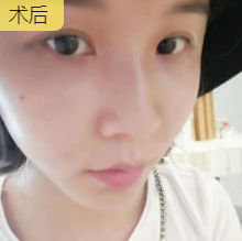 自体脂肪填充术