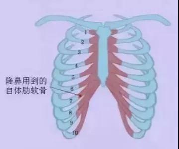 隆鼻手术
