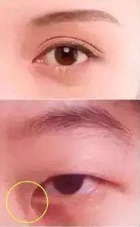 双眼皮手术