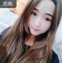 双眼皮手术