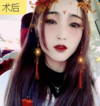 双眼皮手术
