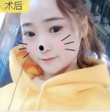 双眼皮手术