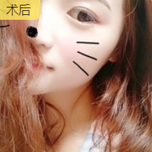 双眼皮手术